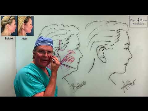 SMAS vs Deep Plane Facelift: What You Need to Know | Philadelphia Facelift Surgeon Dr. Claytor