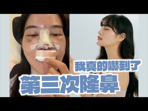 隆鼻3次，全記錄！鼻整形眉角超級多！重修率超高