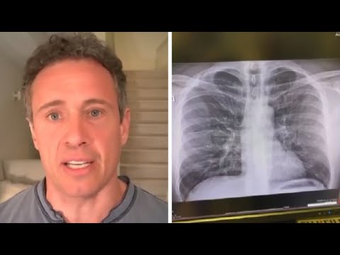 Chris Cuomo Shares Chest X-Ray Amid COVID-19 Battle