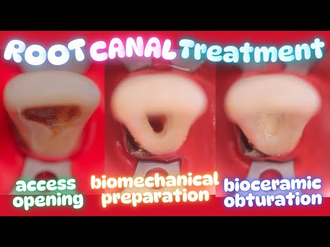 Root Canal Treatment in Maxillary Central Incisor 🟡 Protaper Gold ⚪️ Bioceramic Obturation