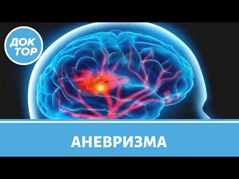 Аневризма сосудов головного мозга: кто в группе риска?