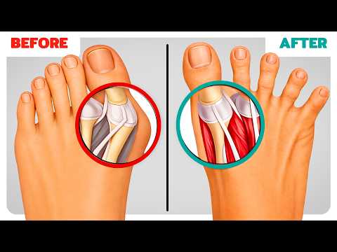 How to Build Feet So Strong You Never Get Bunions Again