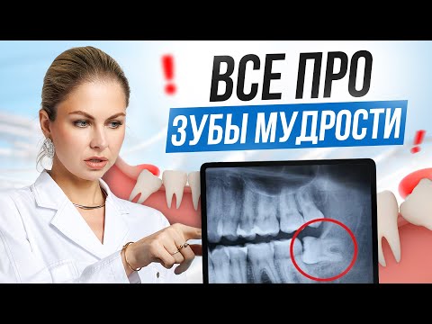 Зубы мудрости: зачем нужны, когда удалять и какие могут быть осложнения
