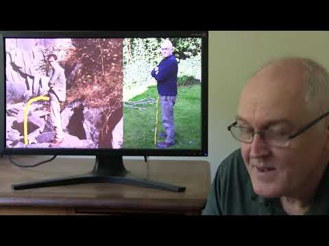 Prostate gland enlargement.