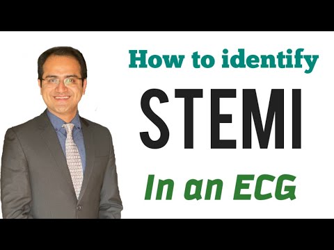 Myocardial Infarction (MI) ECG Changes Interpretation, Ischemia & Infarction  Explained, ECG Lecture