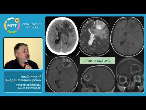Glial brain tumors