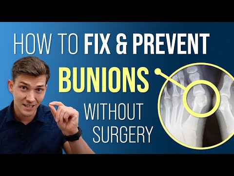 How to Fix & Prevent Bunions Without Surgery!