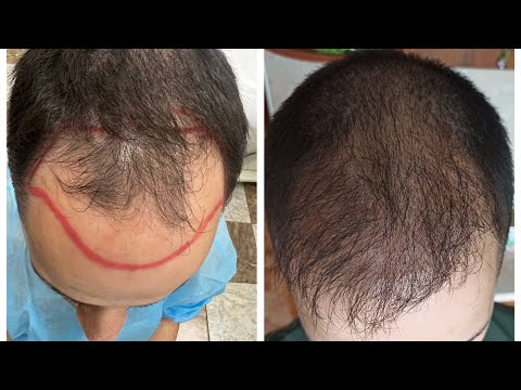 Неудачная пересадка волос в географт ggmed 