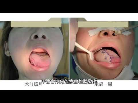 扁桃腺發炎有何症狀?醫生會如何治療與處裡?