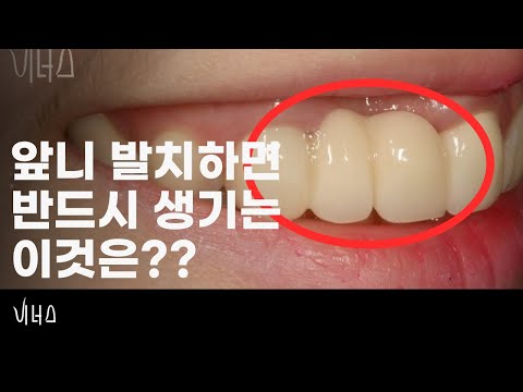 발치하면생기는일  I  앞니 치과 비너스 원장의 앞니 치료 이야기