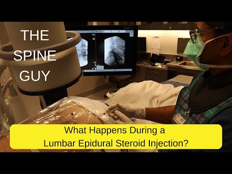 What Happens During a Lumbar Epidural Steroid Injection?