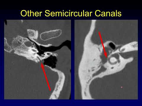 Third Window Phenomena