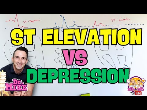 ST Elevation vs ST Depression