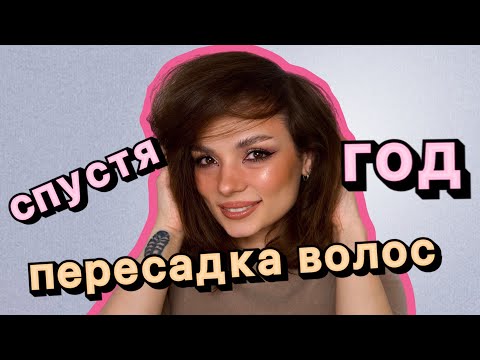 Пересадка волос, год спустя. #ugolekmakeup  #пересадкаволос #пересадкаволосгодспустя