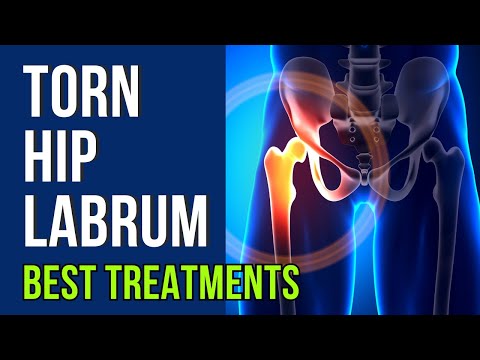 Torn Hip Labrum: The Best Treatment Options