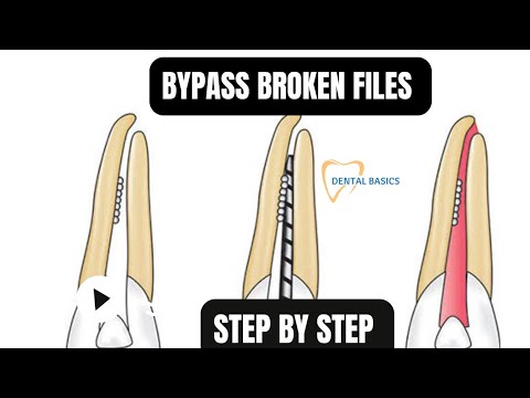 Easily Bypass Broken Files | A Clinical Guide