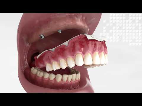 Smart Denture Conversions Animation