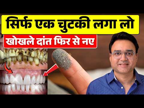 ये आयुर्वेदिक दन्त मंजन लगा लो - कीड़ा लगे, पीले, खोखले दांत फिर से नए कर देगा | Teeth Cavity