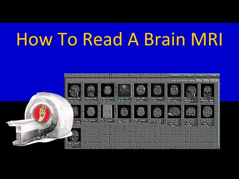 How To Read A Brain MRI - Neuroradiology Made Easy (Maybe?)