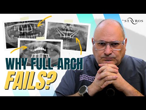 Full Arch Immediate Loading The Basics Surgeons Still Miss