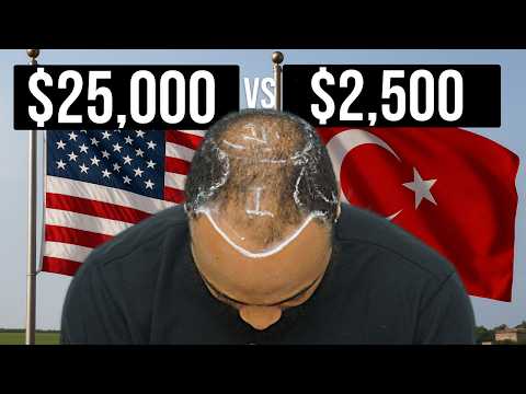 Turkey vs USA Hair Transplant *Costs, Pain, and Travel*