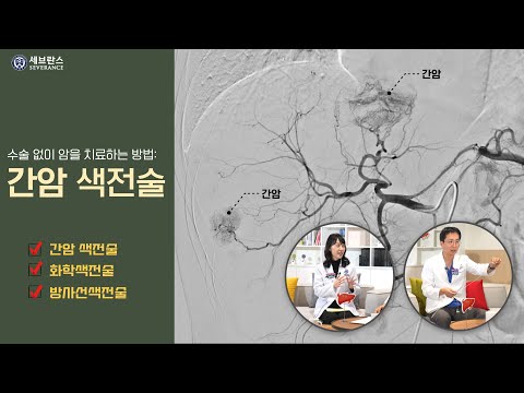 "초기 간암 환자를 위한 치료 가이드" 색전술 편