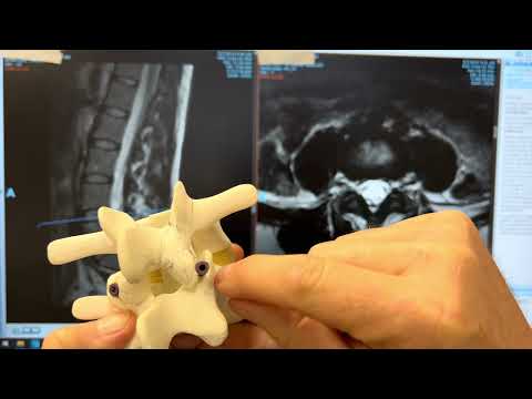 How to read a Lumbar MRI: Stenosis, Arthritis, Degenerative Disc Disease All Explained