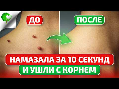 Как отличить ПАПИЛЛОМЫ от ДВОЙНИКОВ и избавиться от них НАВСЕГДА? Папилломы уходят с корнем.