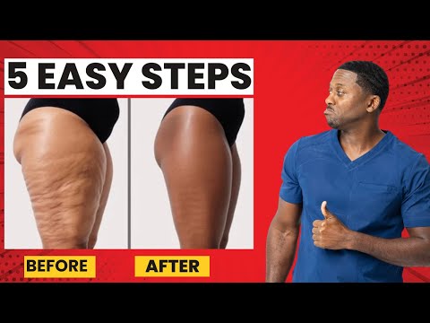 Cellulite Solutions Big Pharma Doesn't Want You To Know About