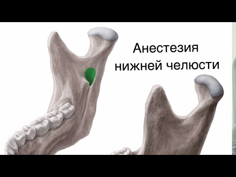 Mandibular anesthesia. Anesthesia of the lower jaw