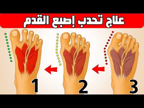 ألم اصبع القدم الكبير || علاج انحراف وتورم وخشونة عظمة ابهام القدم bunions  hallux valgus