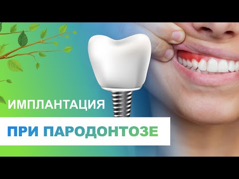 ✔️ Имплантация зубов при пародонтозе