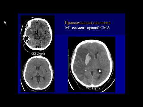 Костеников А.Н.«Неотложная КТ, МРТ, ЦАГ ишемического инсульта в условиях сосудистого центра»