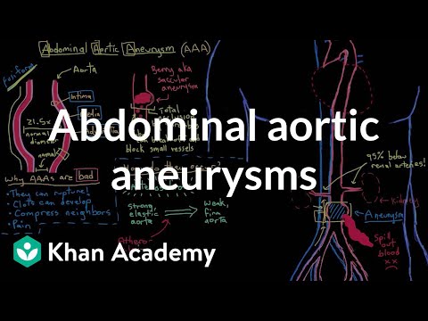 Abdominal aortic aneurysms | Circulatory System and Disease | NCLEX-RN | Khan Academy