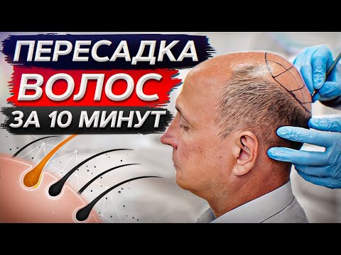 Можно ли ПЕРЕСАДИТЬ искусственные ВОЛОСЫ? / Вся ПРАВДА о пересадке волос!