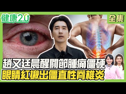 趙又廷罹類風濕關節炎晨醒關節腫痛僵硬！女星乾癬全身冒紅斑引35種共病！李東健紅眼揪僵直性脊椎炎！2招緩脊椎痛！健康2.0 20251213【完整版】#陳欣湄#韋汝#黃光永#柳朋馳#鄒瑋倫#胡逸惟#彥寬