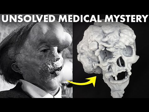 How the Elephant Man Defied ALL Medical Knowledge