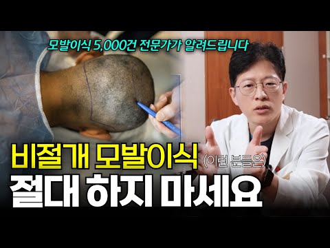 비절개모발이식, 환자 90%가 모르는 위험과 진실!! 모발이식 11년차 의사로서 양심고백합니다 [압구정모발이식, 강남모발이식]