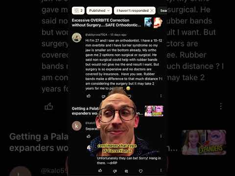 How do you fix a 10-12mm overbite (overjet)? @abbyrose7924 #teeth #dentist #braces