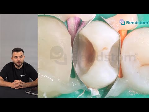 Восстановление по II классу. Поддесневые дефекты. Сергей Елисеев. Разбор клинических случаев №1