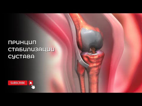 Принцип стабилизации сустава. Малиновская
