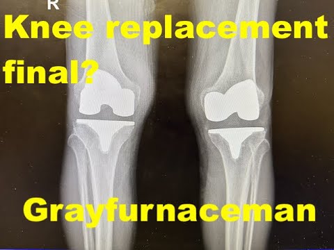 Final knee replacement video (I hope)