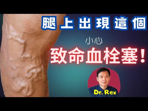 (中英字幕EngSub) 總是不明白為何有靜脈曲張? 又搞不清治療方法原理是什麼？快來看本片立即了解明白 varicose veins explained in very simple terms