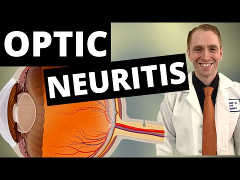 Optic Neuritis Symptoms, Diagnosis, and Treatment