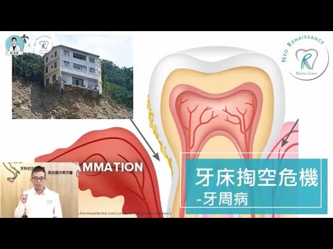 【牙周病，牙床的掏空危機】牙周病到底是什麼？該如何治療？｜Dr. 林葳牙科診療室