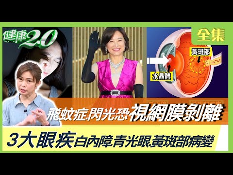 梁修身驚爆 白內障 青光眼 黃斑部病變！ 飛蚊 閃光恐 視網膜剝離！護眼7大營養素！ 健康2.0 20230521【完整版】鄭凱云 陳瑩山 周宗賢 吳映蓉 許聖梅 陳之穎 @tvbshealth20