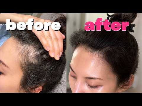 Reverse Hair Loss Naturally | Stop Hair Fall & Regrow Thinning Hair Fast