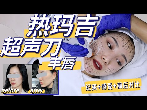 Thermage/Ultherapy/lip augmentation| True feeling after 2 months|  Is it worth it? How much?