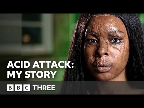 My Acid Survivor Story: Betrayed By A Friend
