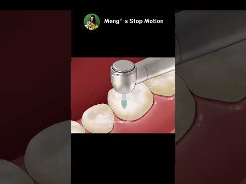 Dental Caries Damages Tooth! AMAZING Dental ASMR Animation! | Meng's Stop Motion